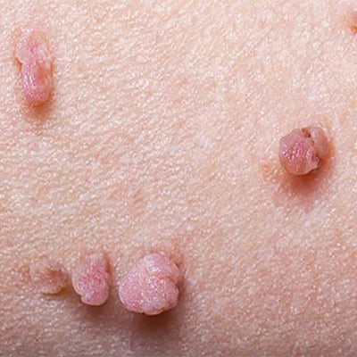 Gewöhnliches Fibrom
