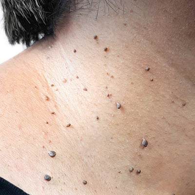 <strong>Pigmentiertes Fibrom</strong>